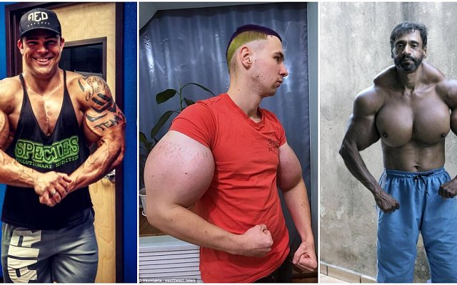 Hazard so zdravím: Synthol môže spôsobiť amputáciu končatín či smrť