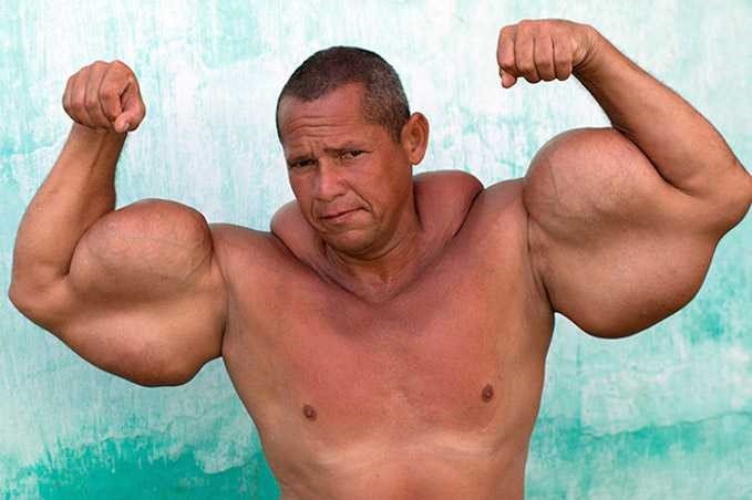 Poznáš synthol, takto to dopadne, keď sa to s ním preženie